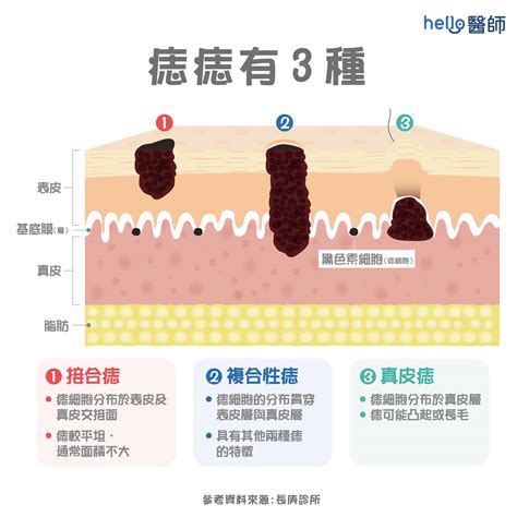 臉頰長痣|痣變大、痣多或長毛會變皮膚癌？認識痣的形成與原因